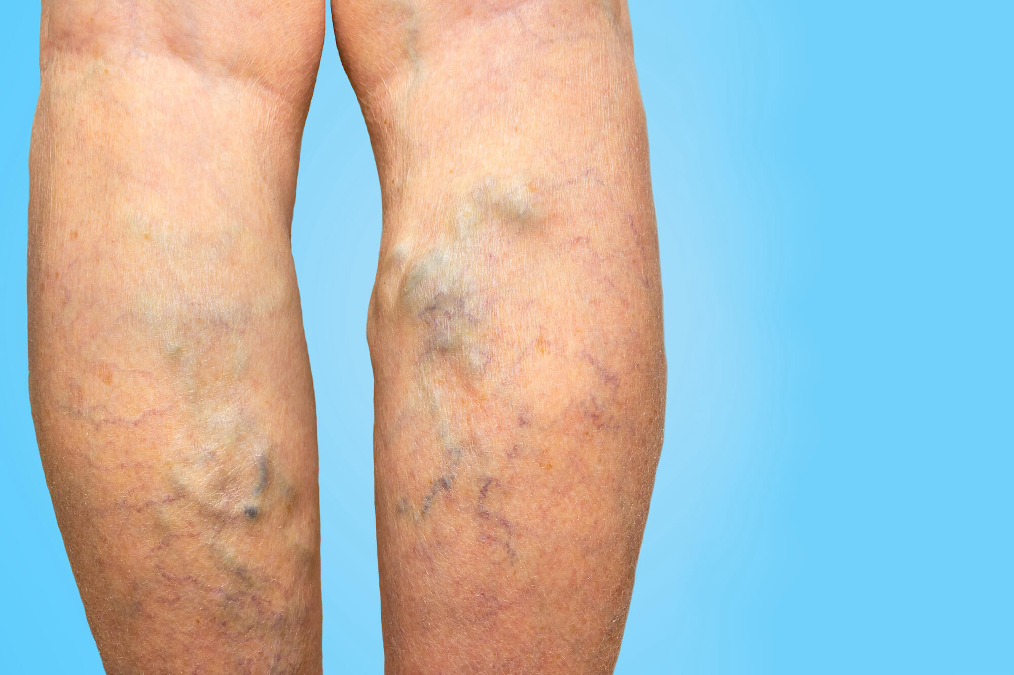 what-are-varicose-veins